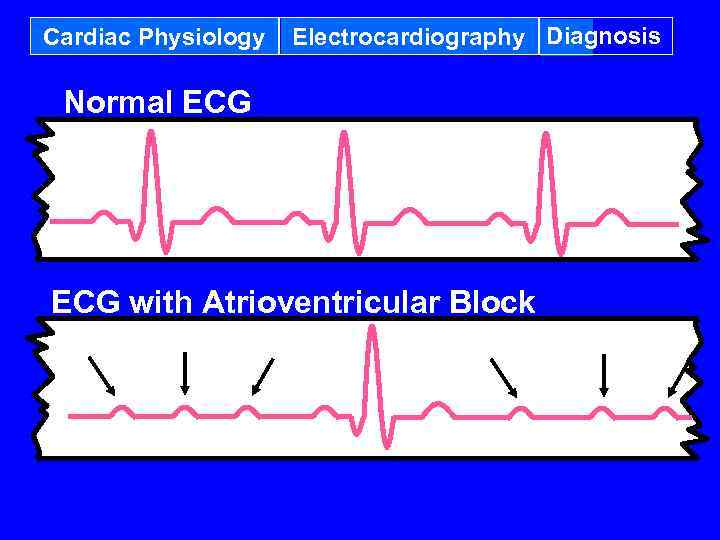 Cardiac Physiology Electrocardiography Diagnosis Normal ECG with Atrioventricular Block 