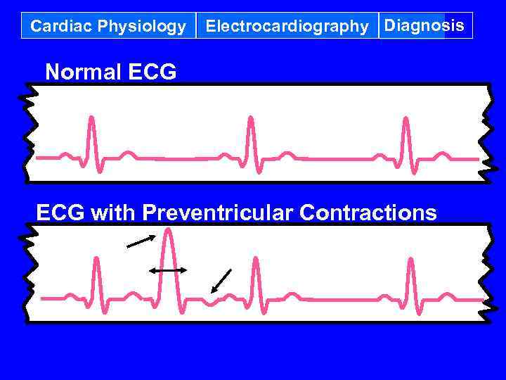 Cardiac Physiology Electrocardiography Diagnosis Normal ECG with Preventricular Contractions 