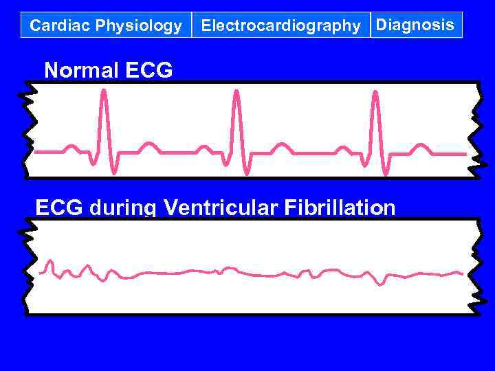 Cardiac Physiology Electrocardiography Diagnosis Normal ECG during Ventricular Fibrillation 