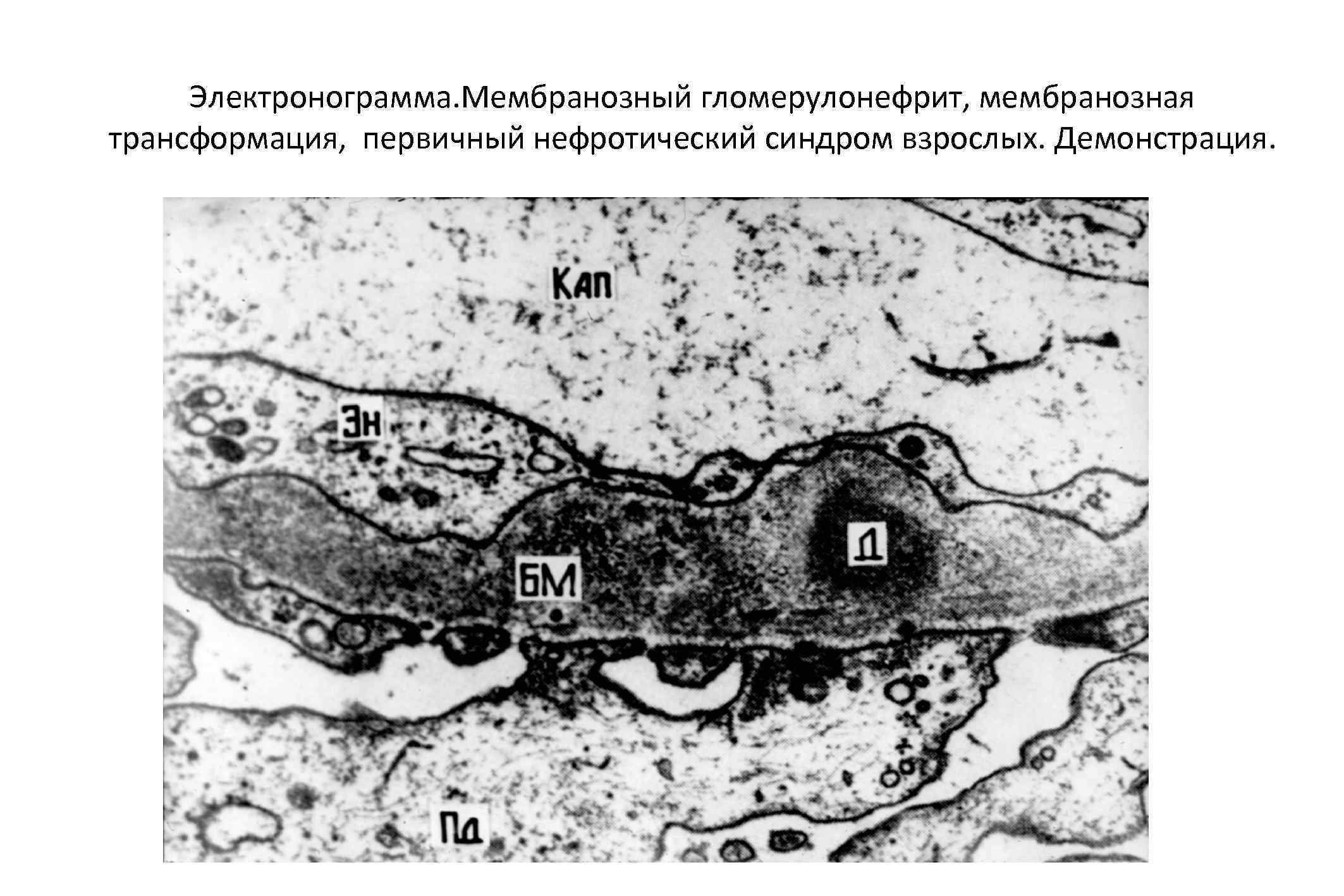 Электронограмма. Мембранозный гломерулонефрит, мембранозная трансформация, первичный нефротический синдром взрослых. Демонстрация. 
