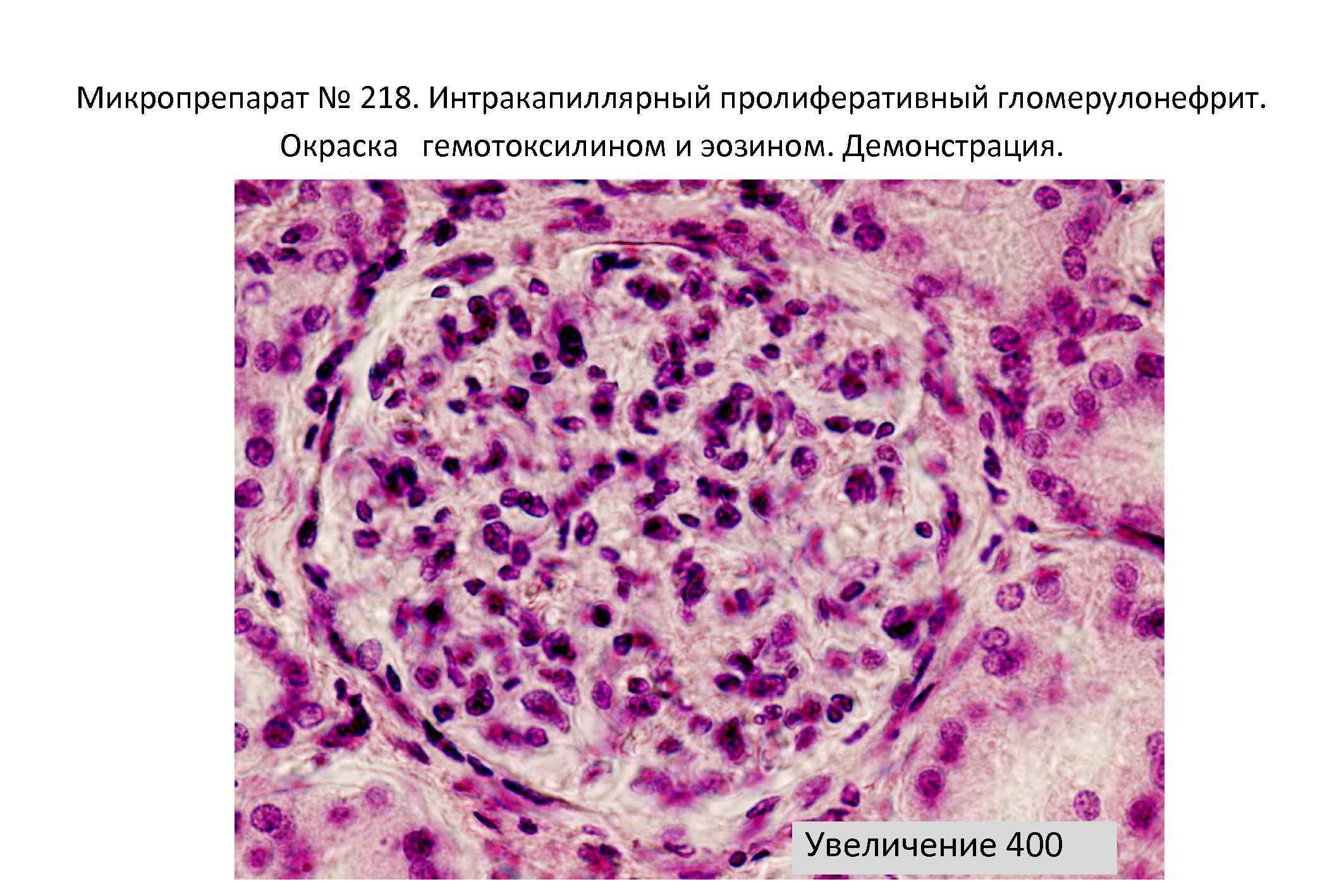 Гломерулонефрит патанатомия презентация