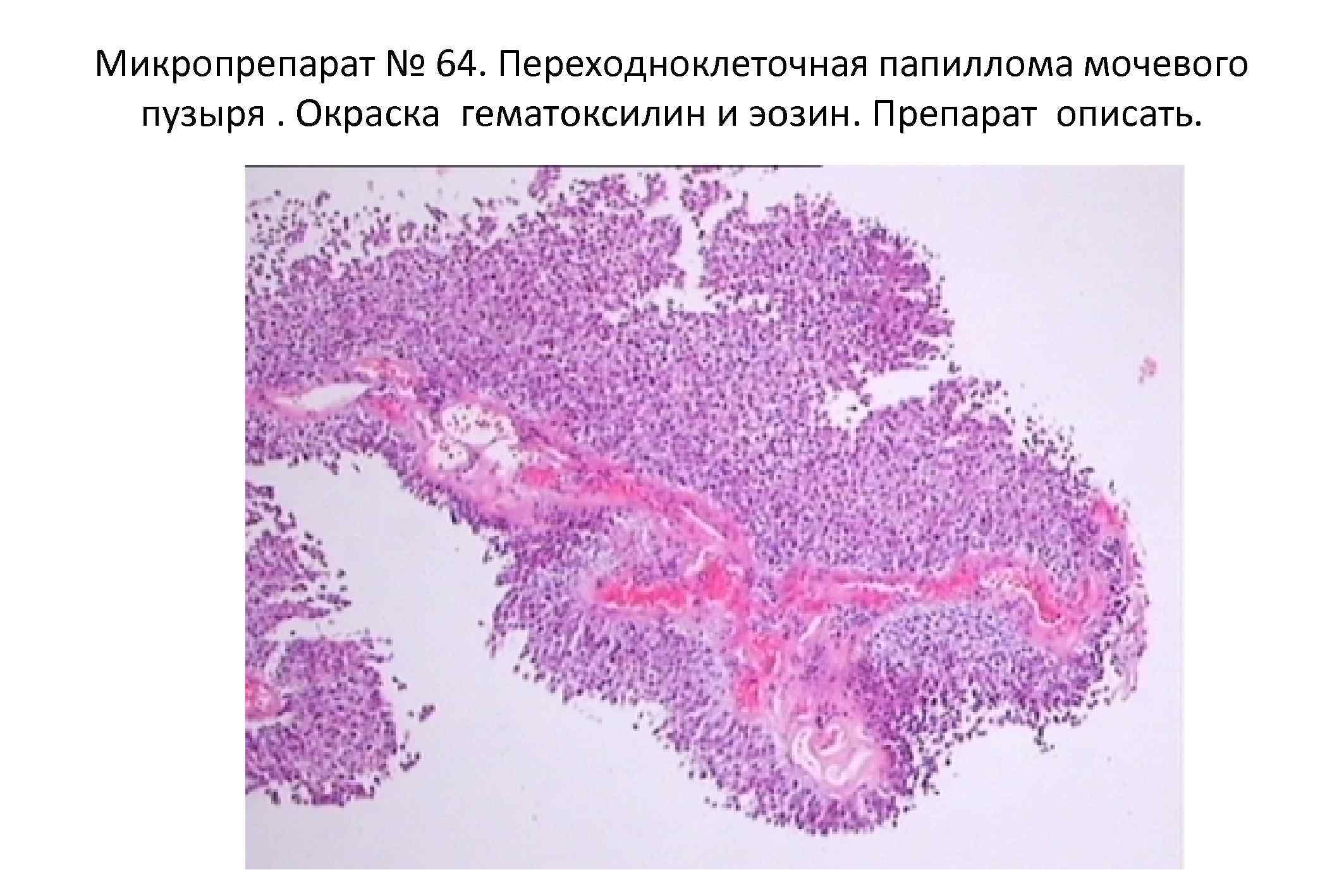 Папиллома мочевого