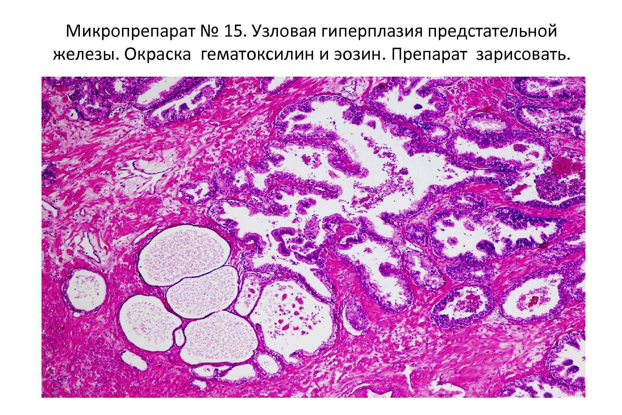Микропрепарат № 15. Узловая гиперплазия предстательной железы. Окраска гематоксилин и эозин. Препарат зарисовать. 