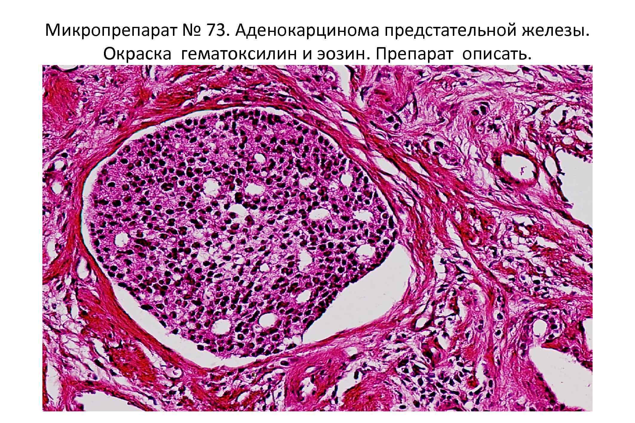 Микропрепарат аденокарцинома желудка рисунок