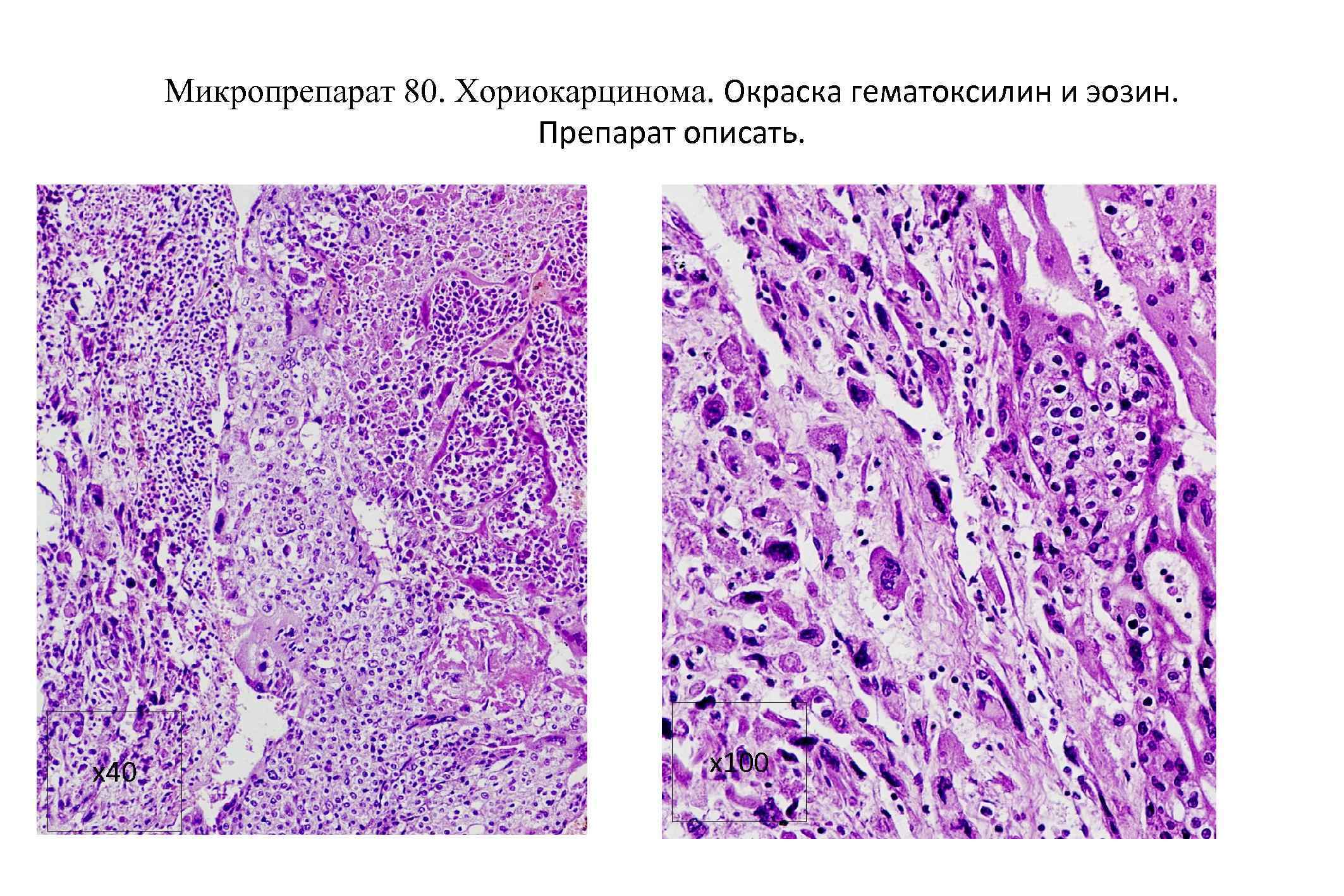 Эндоцервикоз микропрепарат рисунок