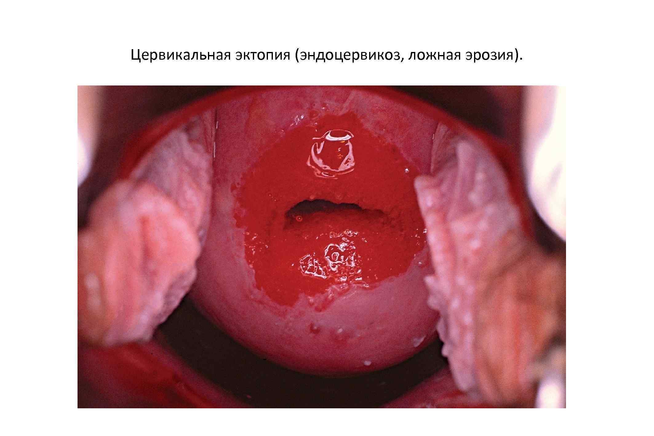 Цервикальная эктопия (эндоцервикоз, ложная эрозия). 