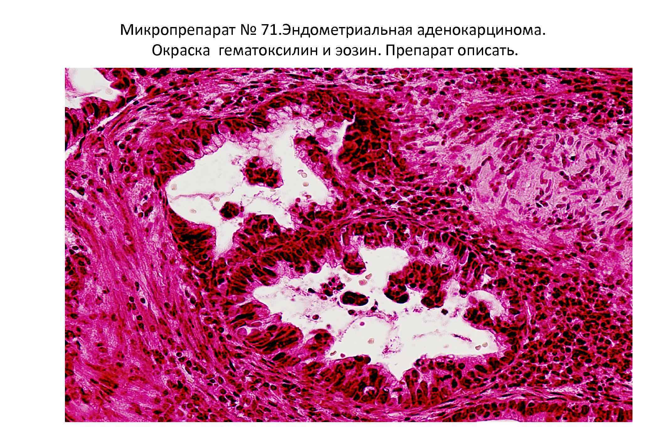 Что такое эндоцервикоз. Эндометриальная аденокарцинома микропрепарат. Эндоцервикоз гистология. Эндоцервикоз шейки матки микропрепарат. Эндоцервикоз гематоксилин.
