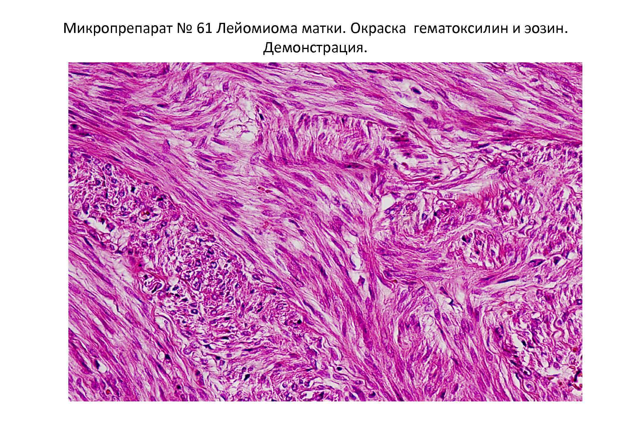 Фибролейомиома матки гистология