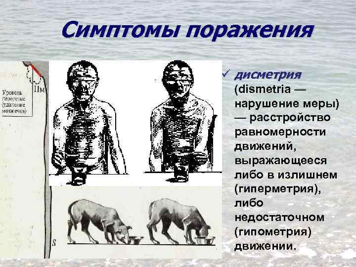 Симптомы поражения ü дисметрия (dismetria — нарушение меры) — расстройство равномерности движений, выражающееся либо