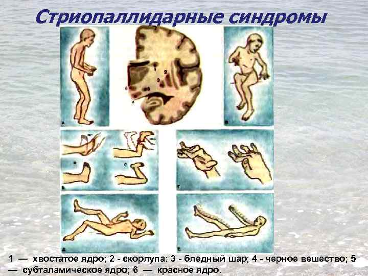 Стриопаллидарные синдромы 1 — хвостатое ядро; 2 - скорлупа: 3 - бледный шар; 4