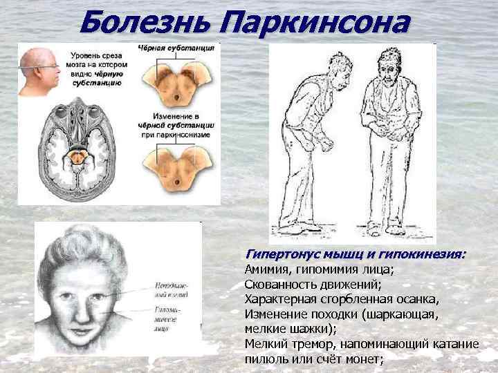 Болезнь Паркинсона Гипертонус мышц и гипокинезия: Амимия, гипомимия лица; Скованность движений; Характерная сгорбленная осанка,