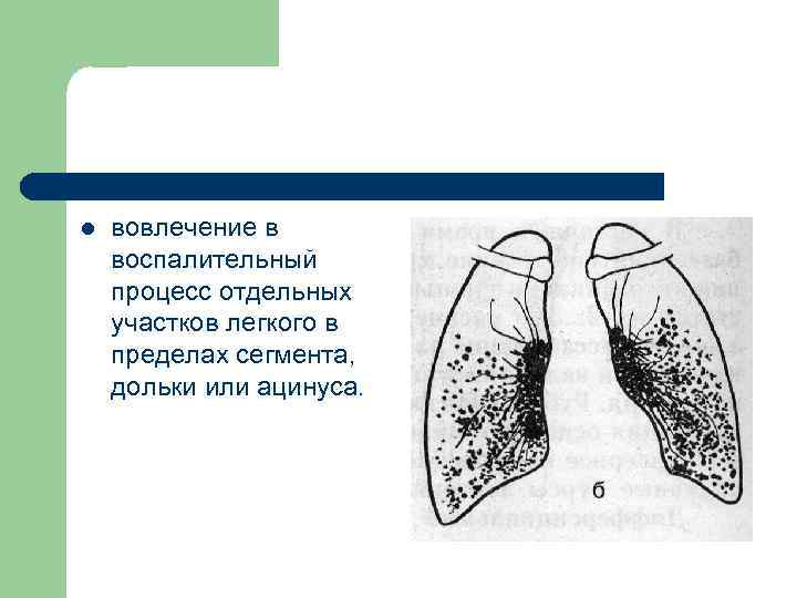l вовлечение в воспалительный процесс отдельных участков легкого в пределах сегмента, дольки или ацинуса.
