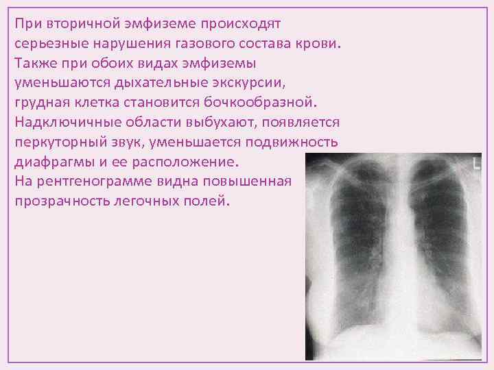 Флюорография легочный рисунок. Эмфизема на флюорографии. Повышение прозрачности легочных полей. Прозрачность в рентгенограмме. Повышение прозрачности легких.