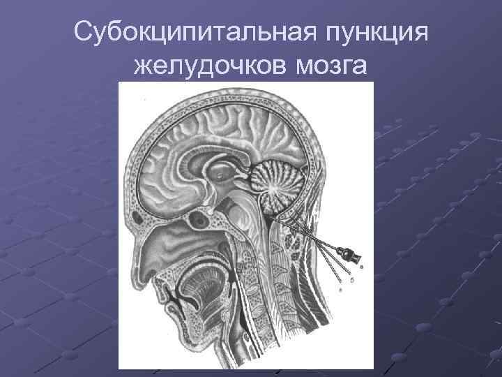 Субокципитальная пункция желудочков мозга 