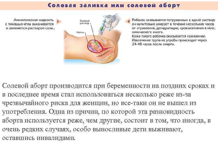 Солевой аборт производится при беременности на поздних сроках и в последнее время стал использоваться