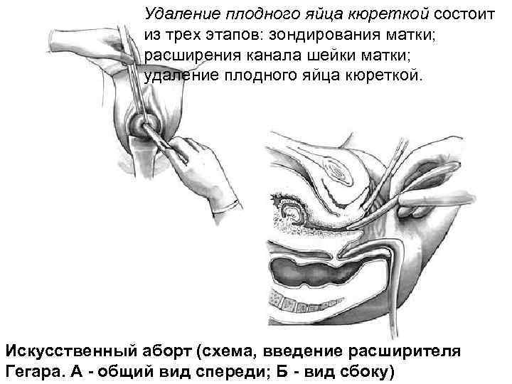 Удаление плодного яйца кюреткой состоит из трех этапов: зондирования матки; расширения канала шейки матки;