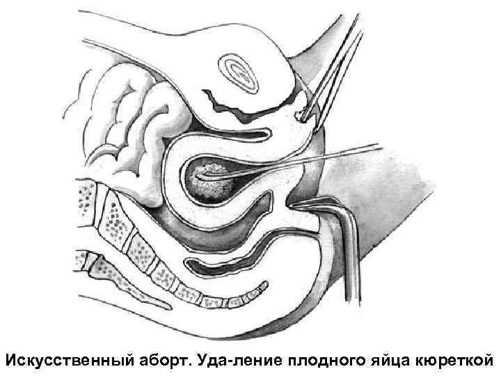Искусственный аборт. Уда-ление плодного яйца кюреткой 