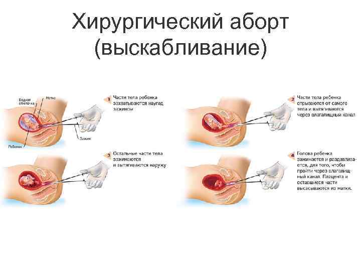 Хирургический аборт (выскабливание) 