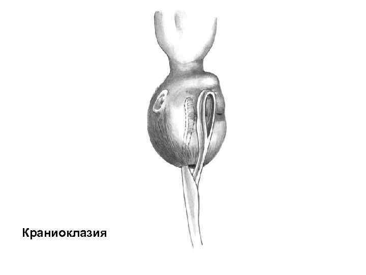 Краниоклазия 