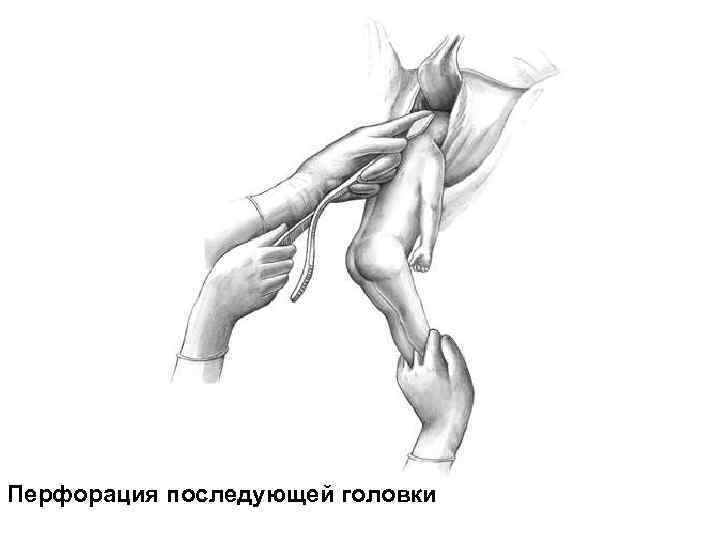 Перфорация последующей головки 