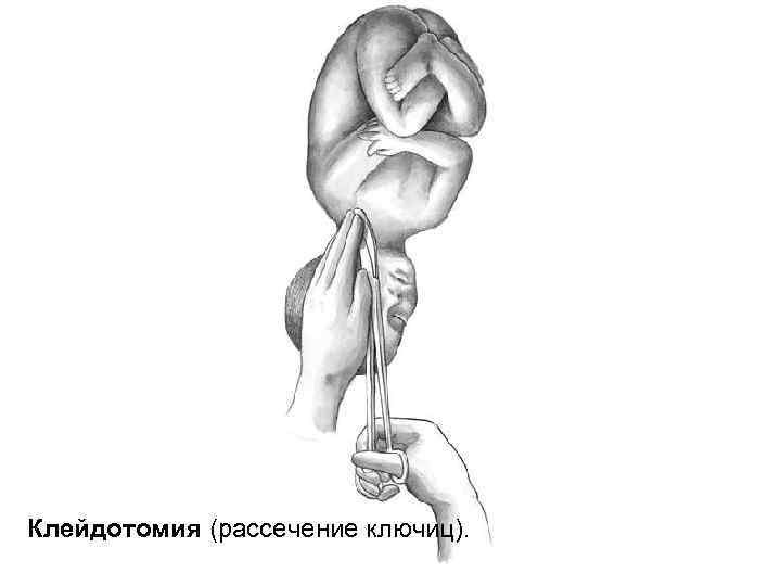 Клейдотомия (рассечение ключиц). 