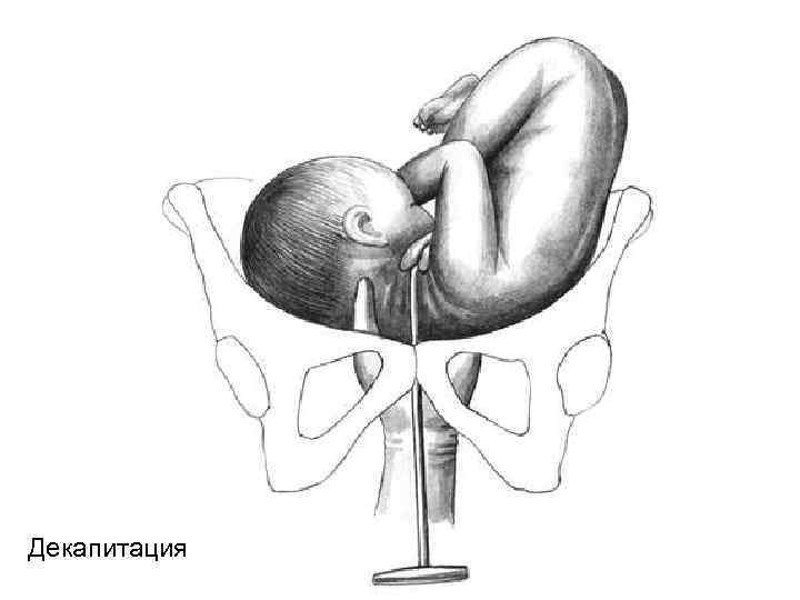 Декапитация 