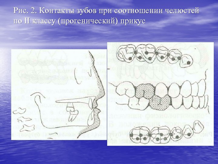 Рис. 2. Контакты зубов при соотношении челюстей по II классу (прогенический) прикус 