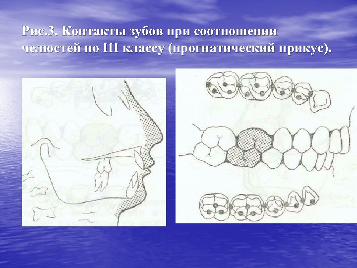 Рис. 3. Контакты зубов при соотношении челюстей по III классу (прогнатический прикус). 