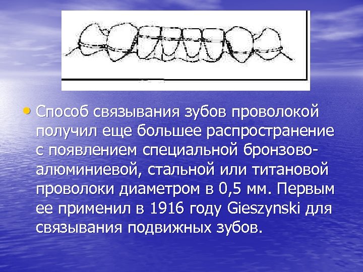  • Способ связывания зубов проволокой получил еще большее распространение с появлением специальной бронзовоалюминиевой,