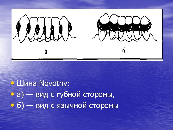  • Шина Novotny: • a) — вид с губной стороны, • б) —