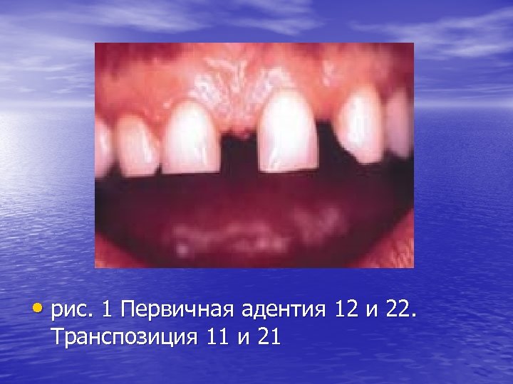  • рис. 1 Первичная адентия 12 и 22. Транспозиция 11 и 21 