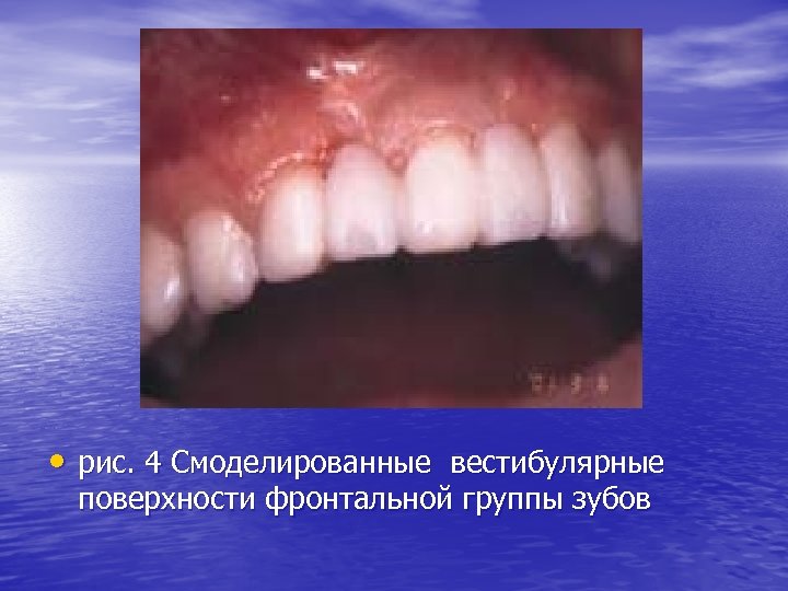  • рис. 4 Смоделированные вестибулярные поверхности фронтальной группы зубов 