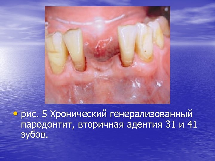  • рис. 5 Хронический генерализованный пародонтит, вторичная адентия 31 и 41 зубов. 