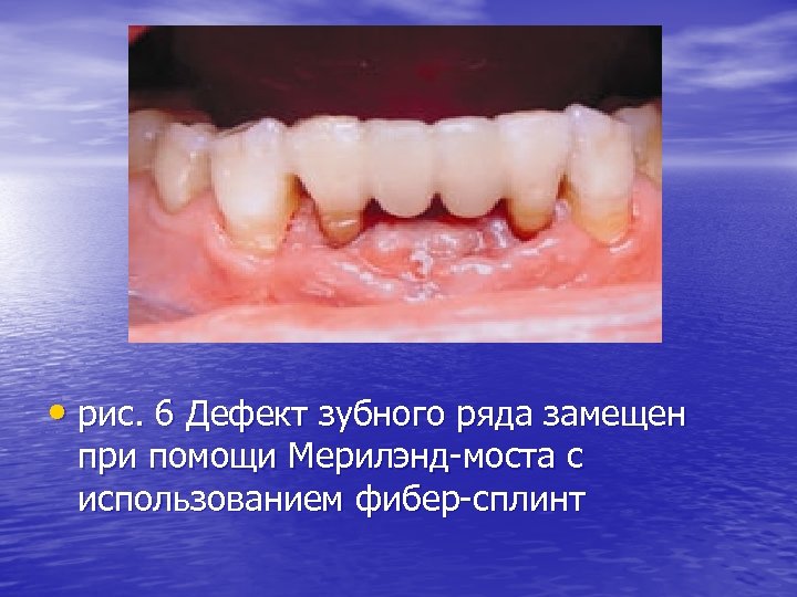  • рис. 6 Дефект зубного ряда замещен при помощи Мерилэнд-моста с использованием фибер-сплинт