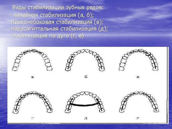  Виды стабилизации зубных рядов: - линейная стабилизация (а, б); -переднебоковая стабилизация (в); -парасагиттальная