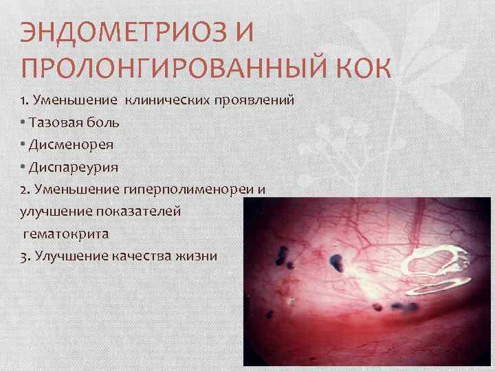 ЭНДОМЕТРИОЗ И ПРОЛОНГИРОВАННЫЙ КОК 1. Уменьшение клинических проявлений • Тазовая боль • Дисменорея •