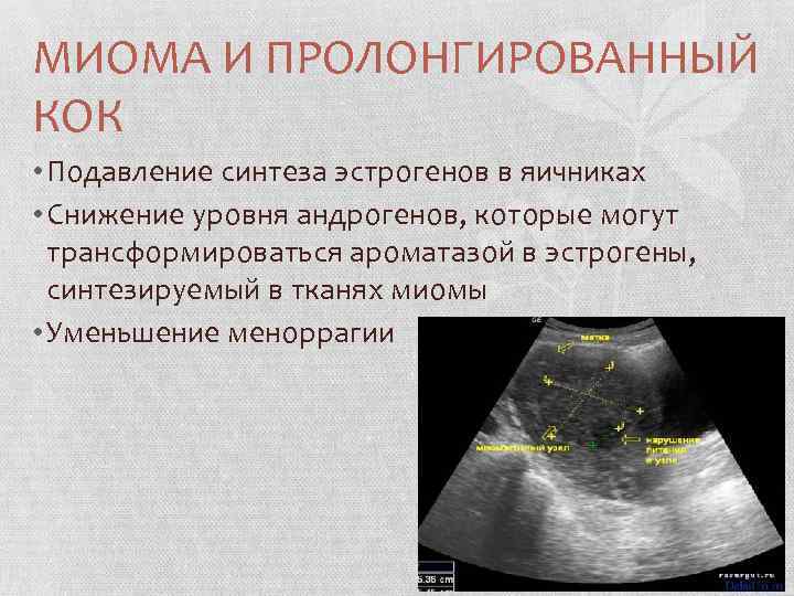 МИОМА И ПРОЛОНГИРОВАННЫЙ КОК • Подавление синтеза эстрогенов в яичниках • Снижение уровня андрогенов,