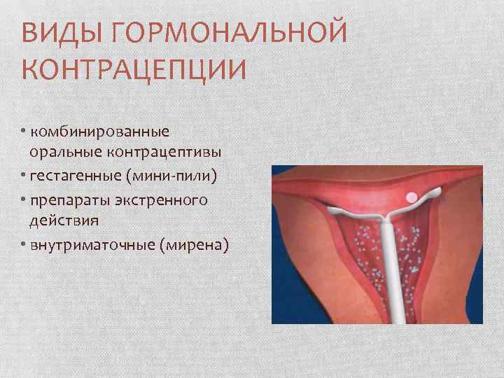 ВИДЫ ГОРМОНАЛЬНОЙ КОНТРАЦЕПЦИИ • комбинированные оральные контрацептивы • гестагенные (мини-пили) • препараты экстренного действия