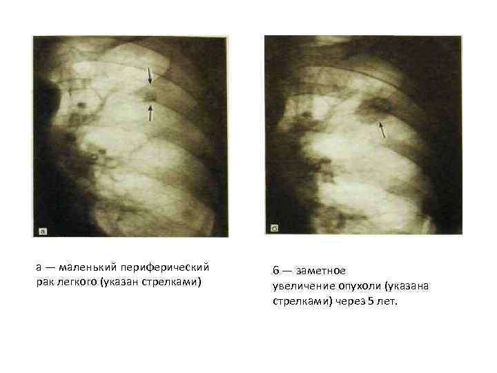 а — маленький периферический рак легкого (указан стрелками) 6 — заметное увеличение опухоли (указана