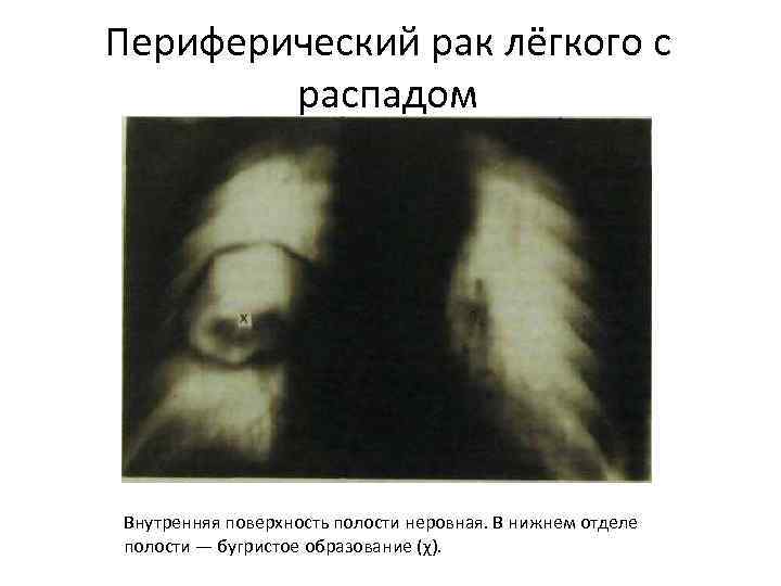 Периферический рак лёгкого с распадом Внутренняя поверхность полости неровная. В нижнем отделе полости —