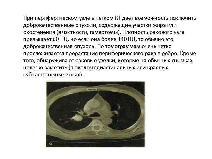 Как часто кт. Доброкачественные опухоли легких на кт. Периферические доброкачественные опухоли легких. Периферическое образование легких доброкачественная на кт. Доброкачественный узел легкого кт.