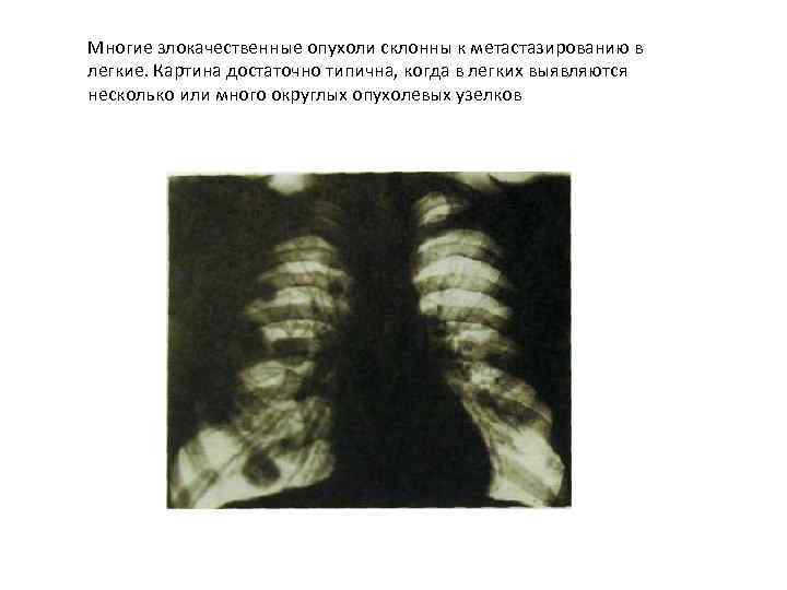 Многие злокачественные опухоли склонны к метастазированию в легкие. Картина достаточно типична, когда в легких