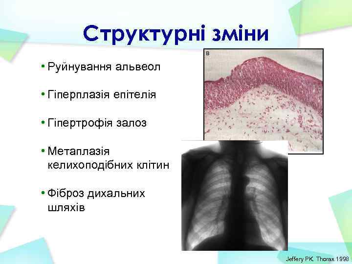 Структурні зміни • Руйнування альвеол • Гіперплазія епітелія • Гіпертрофія залоз • Метаплазія келихоподібних