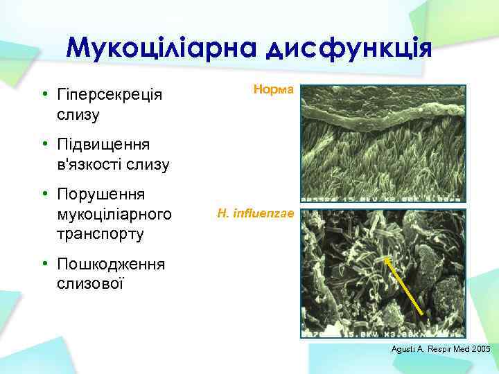 Мукоціліарна дисфункція • Гіперсекреція слизу Норма • Підвищення в'язкості слизу • Порушення мукоціліарного транспорту