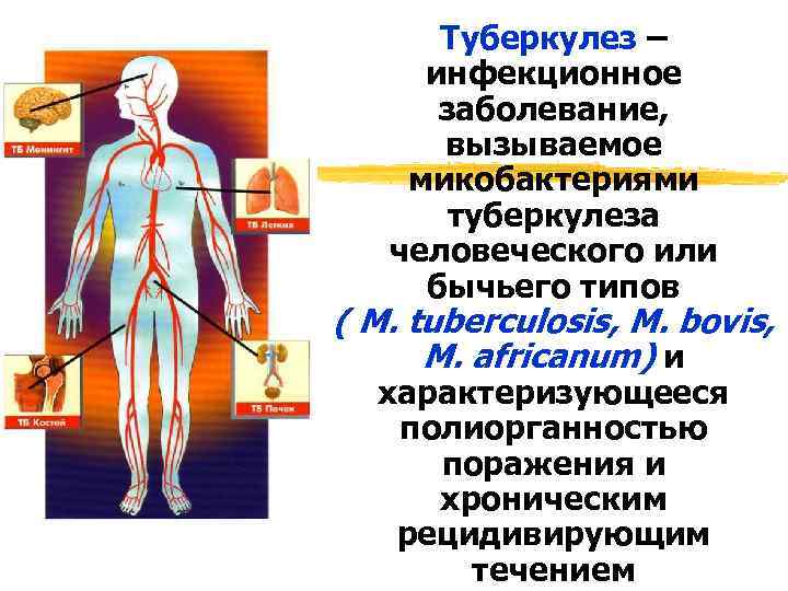 Туберкулез – инфекционное заболевание, вызываемое микобактериями туберкулеза человеческого или бычьего типов ( M. tuberculosis,