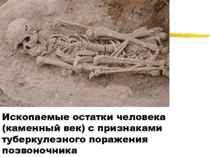 Ископаемые остатки человека (каменный век) с признаками туберкулезного поражения позвоночника 