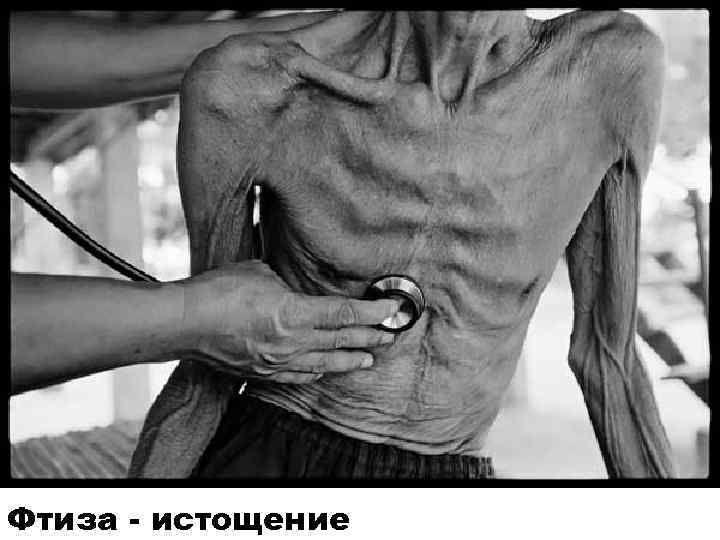 Фтиза - истощение 