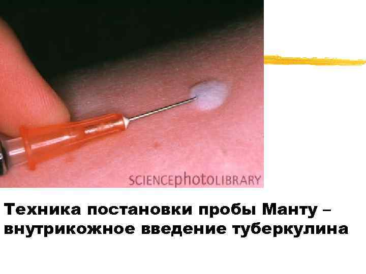 Техника постановки пробы Манту – внутрикожное введение туберкулина 