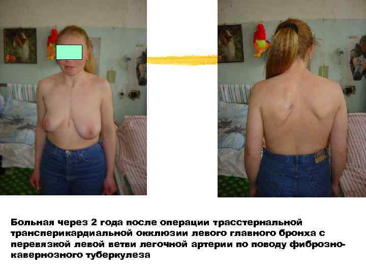 Больная через 2 года после операции трасстернальной трансперикардиальной окклюзии левого главного бронха с перевязкой