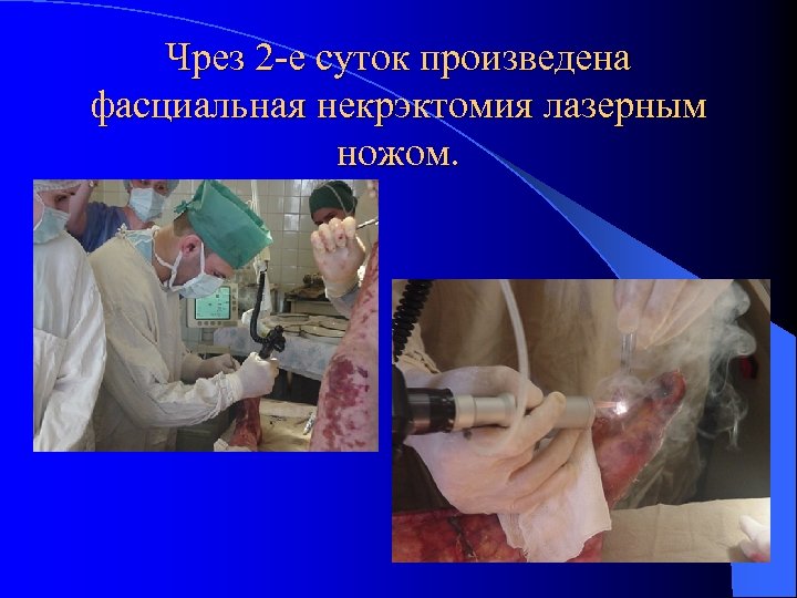 Чрез 2 -е суток произведена фасциальная некрэктомия лазерным ножом. 
